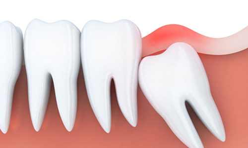 Extraction & Impaction